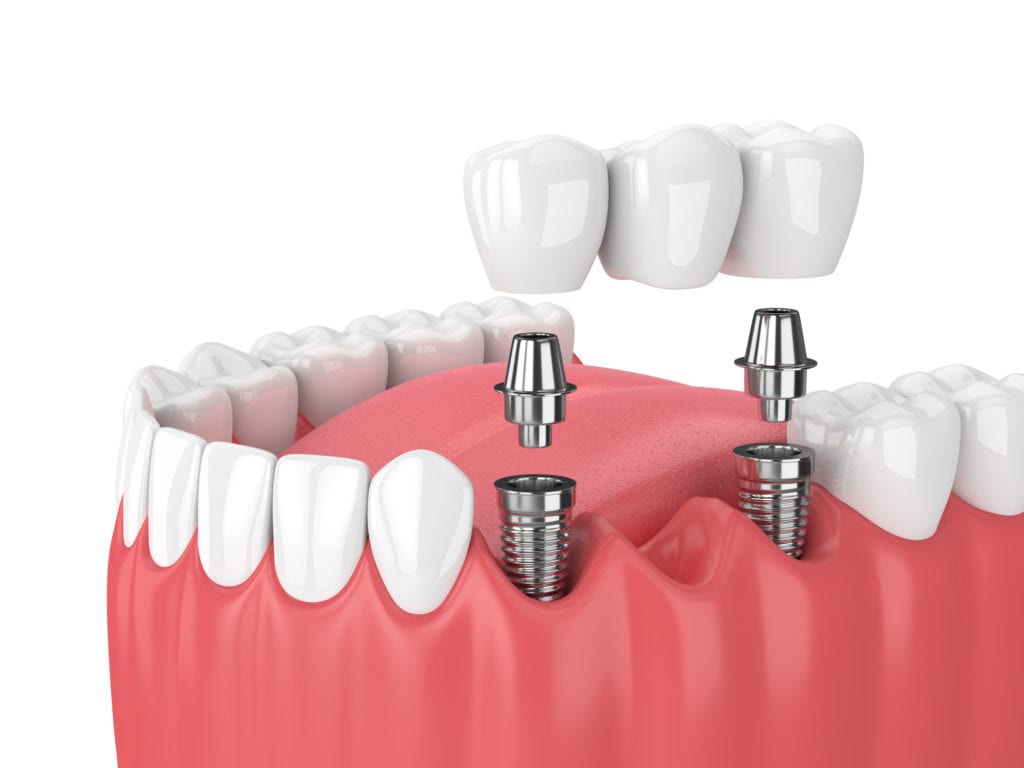 Dental Bridges in Jackson Heights and East Elmhurst, New York