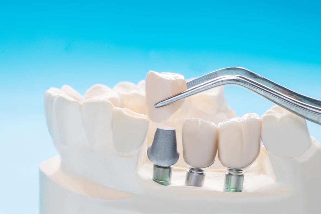 Dental Implants in Jackson Heights and East Elmhurst, New York