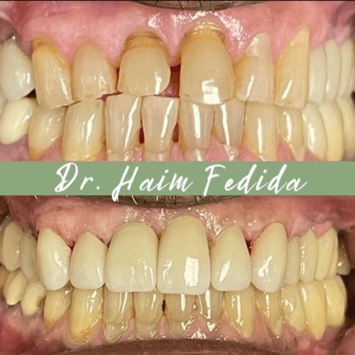 After dentistry at Fedida Family Dentistry & Dental Spa