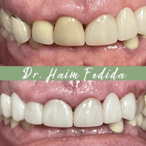 After dentistry at Fedida Family Dentistry & Dental Spa