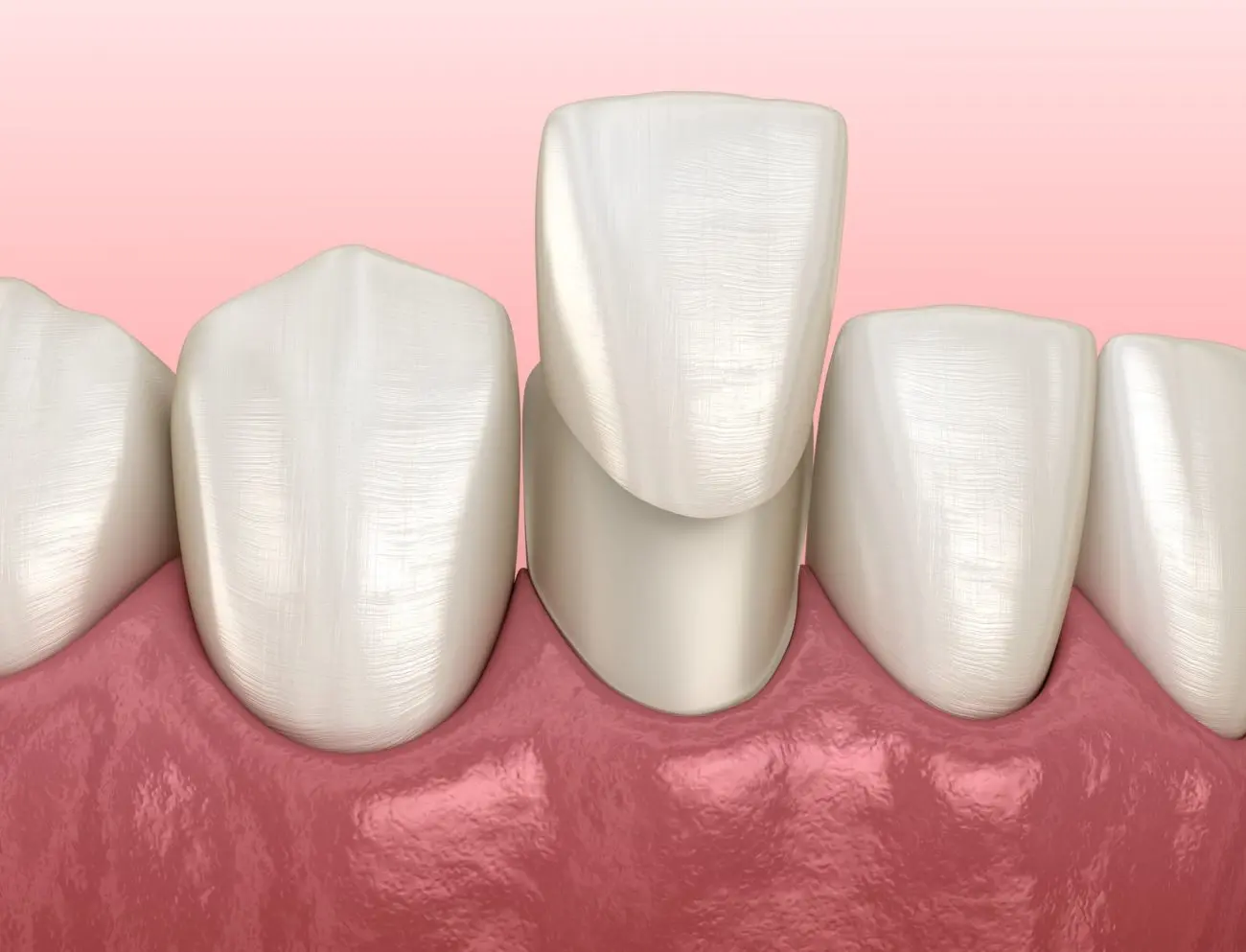 porcelain veneers in Jackson Heights and East Elmhurst, New York