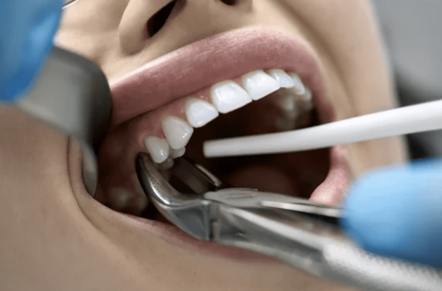 Close-up image of tooth being extracted dentist in Jackson Heights New York