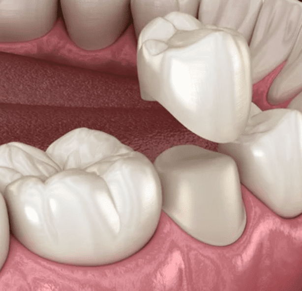 3d render of a dental crown being placed on a tooth restorative dentistry dentist in Jackson Heights New York