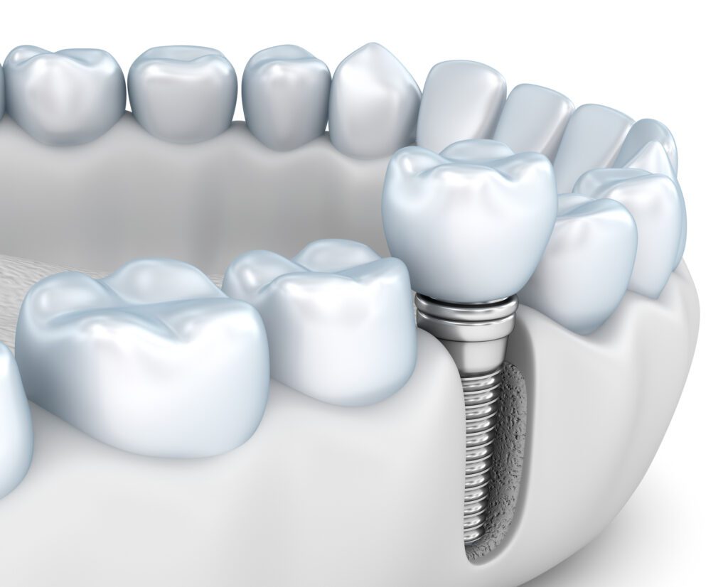 dental implants in Jackson Heights NY can help restore your smile and bite