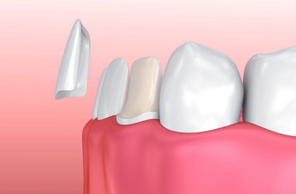 In the realm of cosmetic dentistry, porcelain veneers have emerged as a popular solution for individuals seeking to rectify aesthetic issues