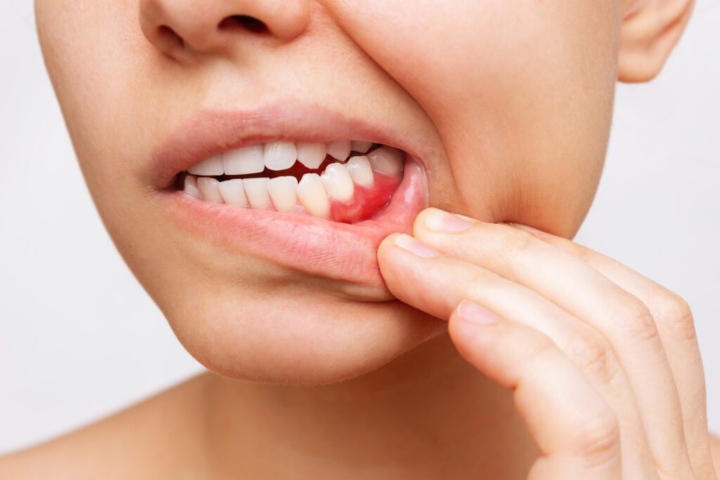 Periodontal Disease Treatment in Jackson Heights NY