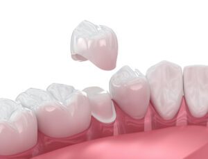 What to Do If a Dental Crown Falls Off in Jackson Heights, NY