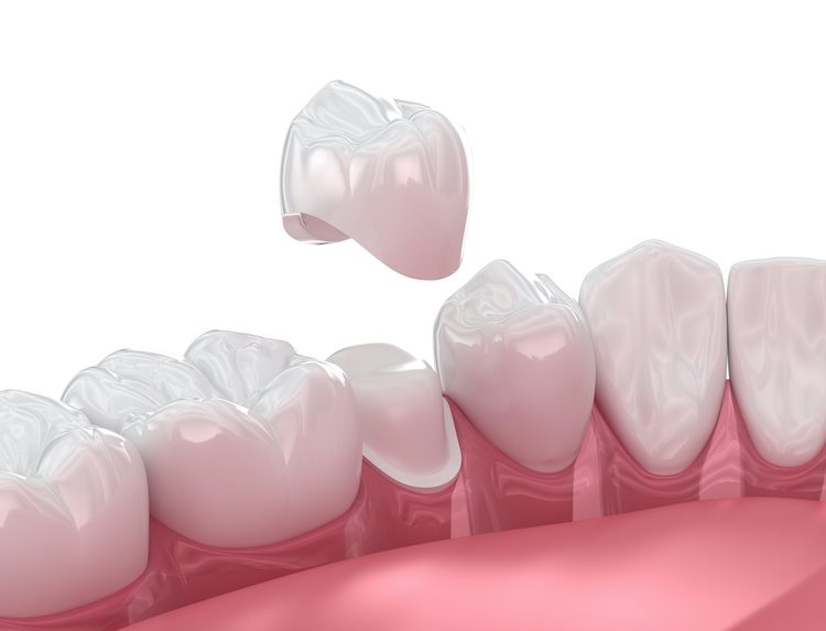 Understanding when you might need a dental crown can help you make informed decisions about your oral health and smile.
