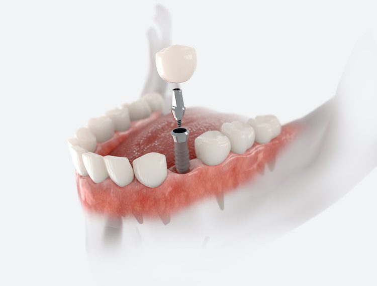 Understanding the dental implant process can help you make informed decisions about your oral health and smile.