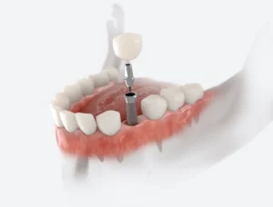 From Missing Tooth to Confident Smile in Jackson Heights, NY